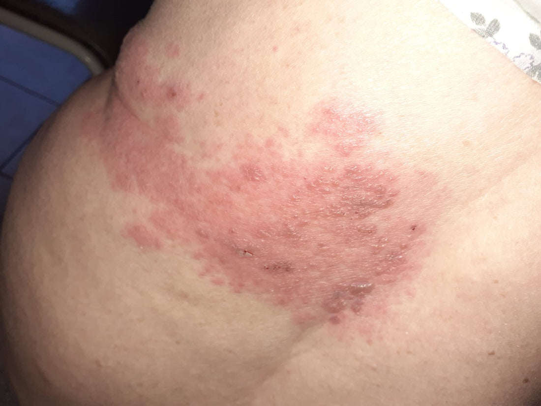 Zona virus herstelt met miHealth toestel